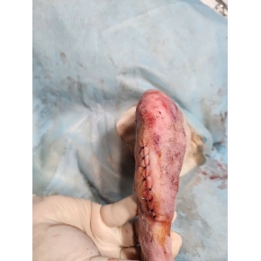 Mổ chỉnh hình gãy xương cho bé tại phòng khám